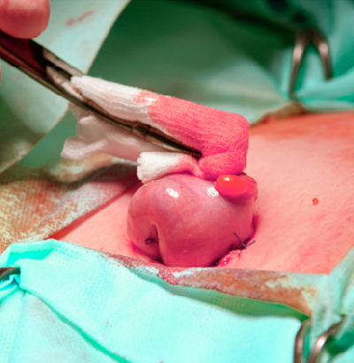 Cancer Surgery Cancer Surgery